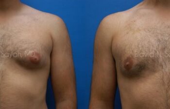 Male Breast Surgery Before and After | Sayah Institute