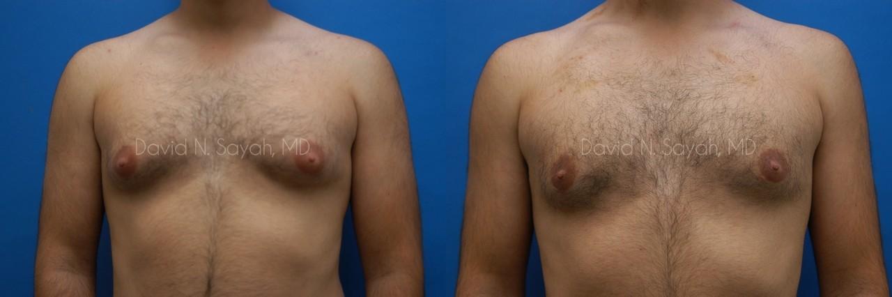Male Breast Surgery Before and After | Sayah Institute