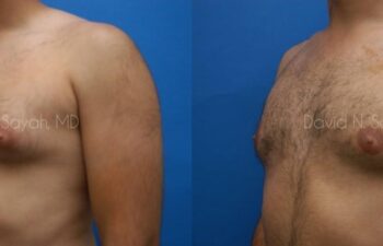 Male Breast Surgery Before and After | Sayah Institute