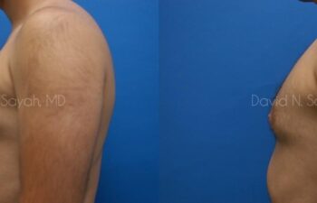Male Breast Surgery Before and After | Sayah Institute