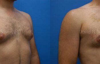 Male Breast Surgery Before and After | Sayah Institute