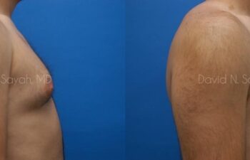 Male Breast Surgery Before and After | Sayah Institute
