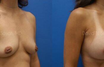 Nipple Revision Before and After | Sayah Institute