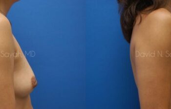 Nipple Revision Before and After | Sayah Institute