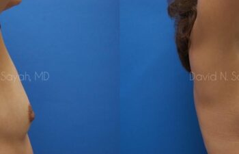 Nipple Revision Before and After | Sayah Institute