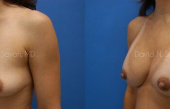 Nipple Revision Before and After | Sayah Institute