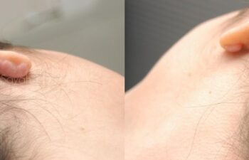 Scar Revision Face Before and After | Sayah Institute