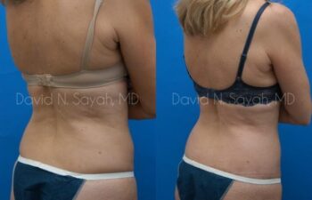Back Tuck Belt Lipectomy Before and After | Sayah Institute