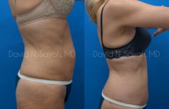 Back Tuck Belt Lipectomy Before and After | Sayah Institute