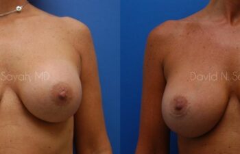 Breast Implant Revision Before and After | Sayah Institute