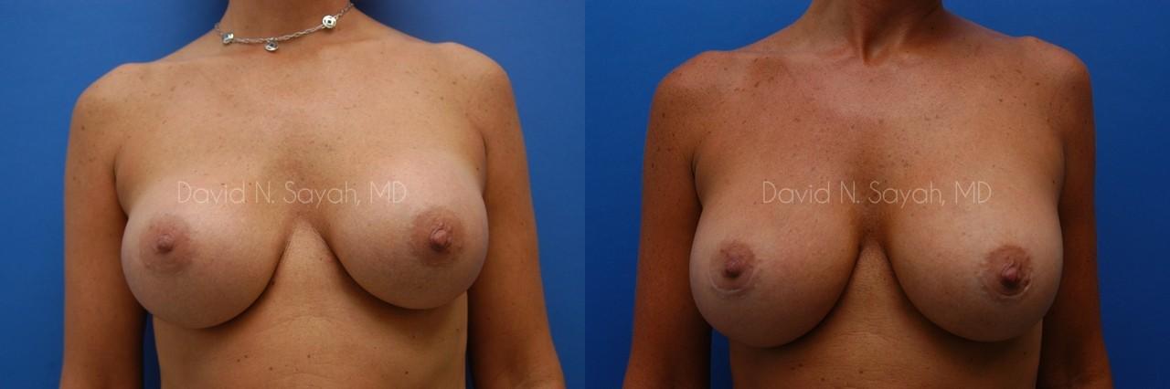 Breast Implant Revision Before and After | Sayah Institute
