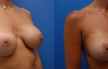 Breast Implant Revision Before and After | Sayah Institute