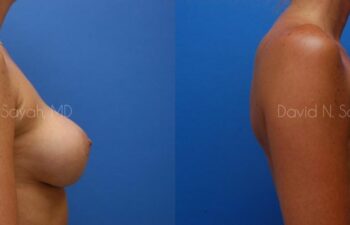 Breast Implant Revision Before and After | Sayah Institute