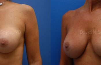 Breast Implant Revision Before and After | Sayah Institute