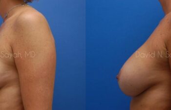 Breast Implant Revision Before and After | Sayah Institute
