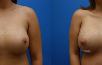 Breast Implant Revision Before and After | Sayah Institute