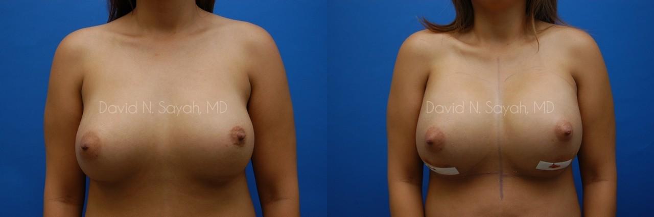 Breast Implant Revision Before and After | Sayah Institute