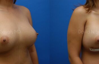 Breast Implant Revision Before and After | Sayah Institute