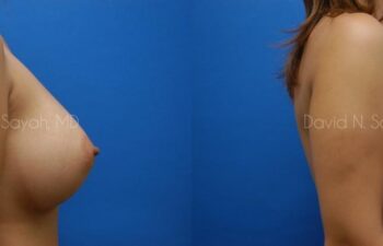 Breast Implant Revision Before and After | Sayah Institute