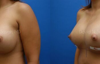 Breast Implant Revision Before and After | Sayah Institute