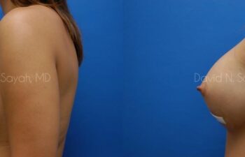 Breast Implant Revision Before and After | Sayah Institute