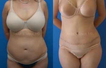 Breast Implant Revision Before and After | Sayah Institute