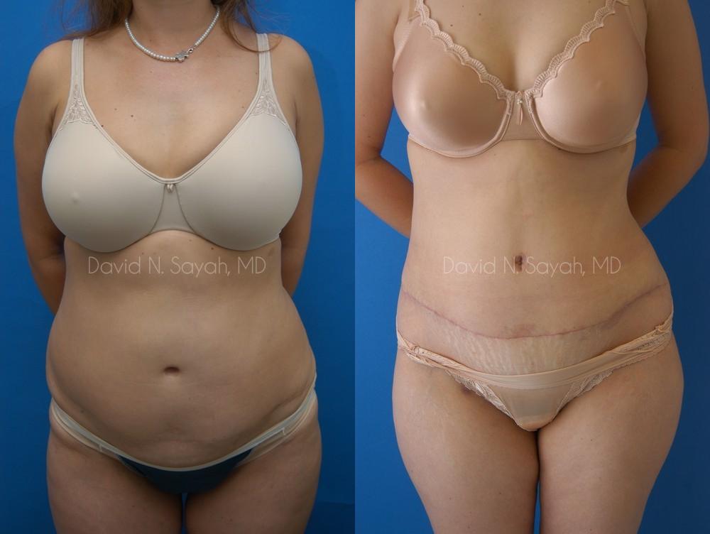 Breast Implant Revision Before and After | Sayah Institute
