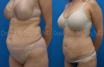 Breast Implant Revision Before and After | Sayah Institute