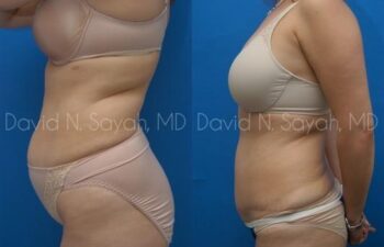 Breast Implant Revision Before and After | Sayah Institute