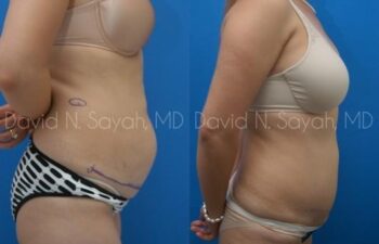 Breast Implant Revision Before and After | Sayah Institute