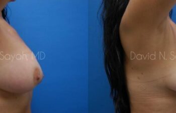 Breast Implant Revision Before and After | Sayah Institute