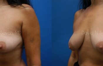Breast Implant Revision Before and After | Sayah Institute