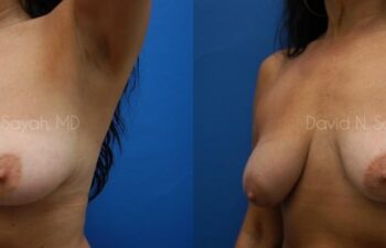 Breast Implant Revision Before and After | Sayah Institute