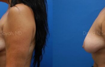 Breast Implant Revision Before and After | Sayah Institute