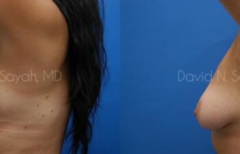 Breast Implant Revision Before and After | Sayah Institute