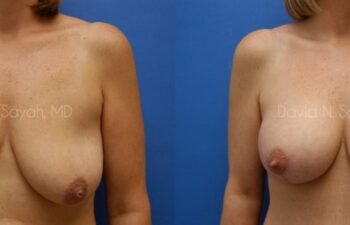 Breast Augmentation And Mastopexy Before and After | Sayah Institute
