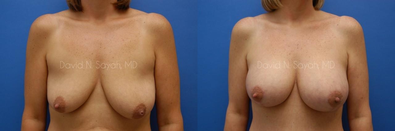 Breast Augmentation And Mastopexy Before and After | Sayah Institute