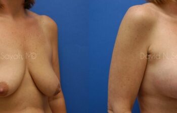 Breast Augmentation And Mastopexy Before and After | Sayah Institute