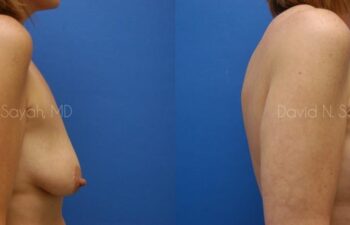 Breast Augmentation And Mastopexy Before and After | Sayah Institute
