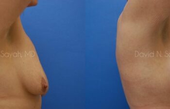 Breast Augmentation And Mastopexy Before and After | Sayah Institute