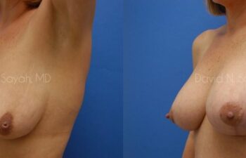 Breast Augmentation And Mastopexy Before and After | Sayah Institute