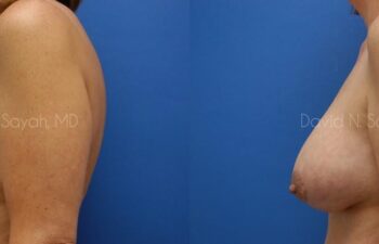 Breast Augmentation And Mastopexy Before and After | Sayah Institute