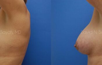 Breast Augmentation And Mastopexy Before and After | Sayah Institute