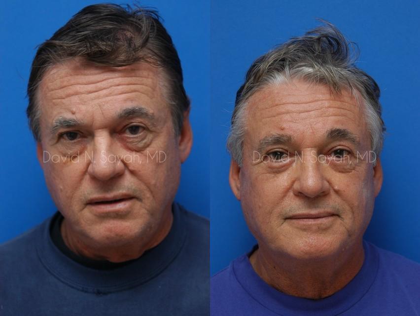 Eyelid Surgery Before and After | Sayah Institute