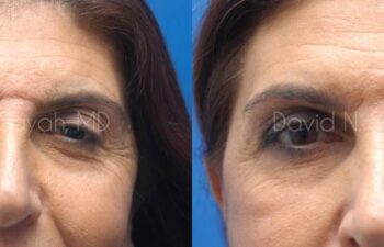 Eyelid Surgery Before and After | Sayah Institute