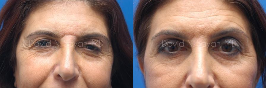 Eyelid Surgery Before and After | Sayah Institute