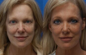 Eyelid Surgery Before and After | Sayah Institute