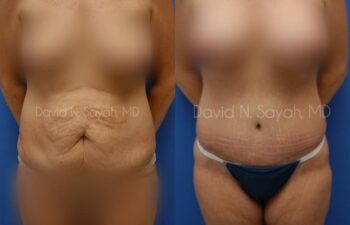 Mommy Makeover Before and After | Sayah Institute