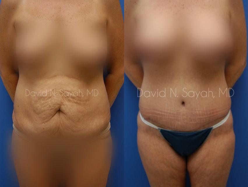 Mommy Makeover Before and After | Sayah Institute