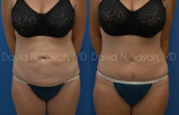 Tummy Tuck Before and After | Sayah Institute
